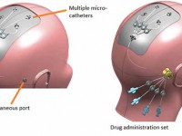 脑癌药物输送系统中的金属3D打印零件